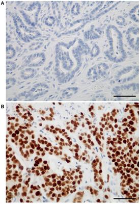 Unfavorable Prognostic Effects of the Stem Cell Pluripotency Factor Sox2 in Feline Invasive Mammary Carcinomas